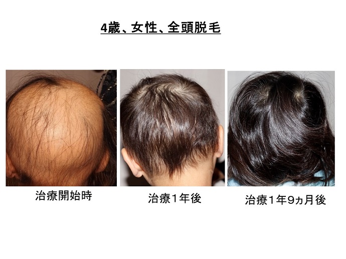 円形脱毛症　病院